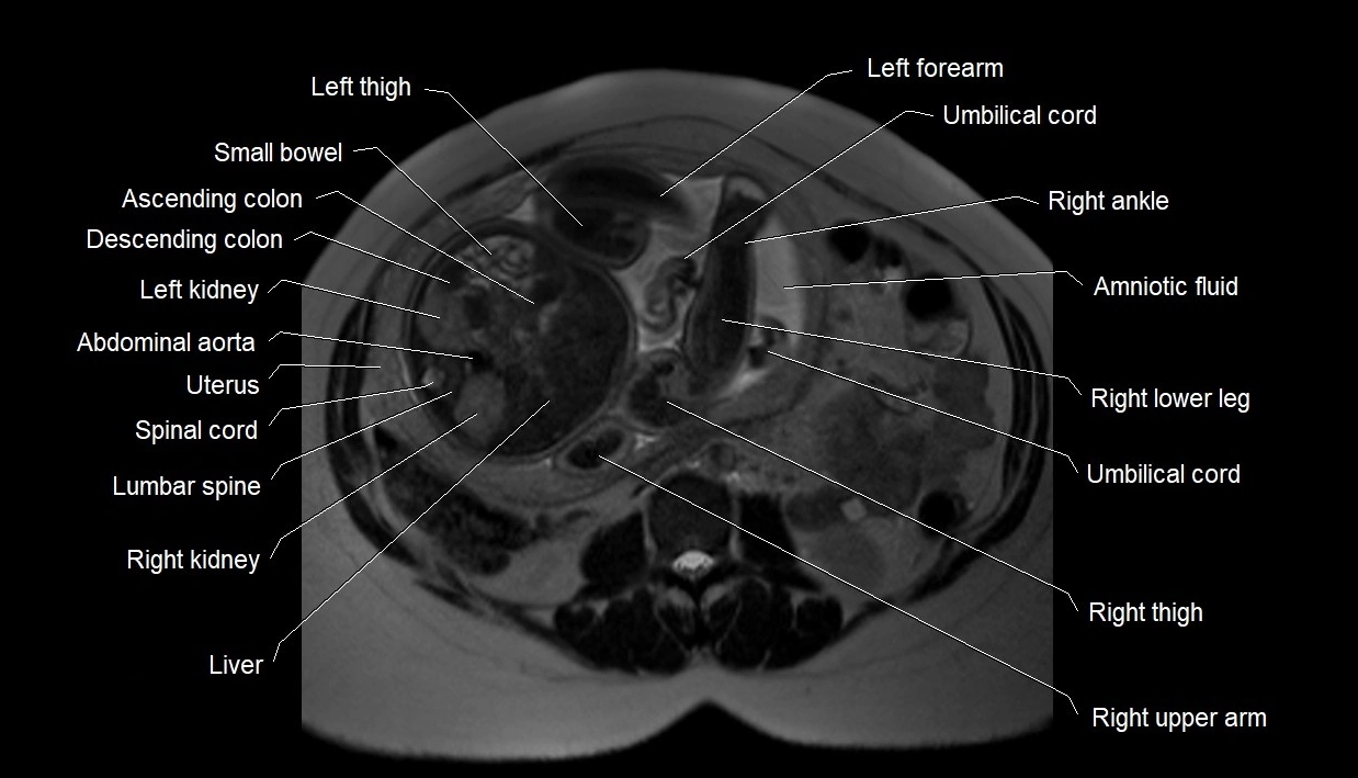 MRI fetal anatomy axial image 10.webp